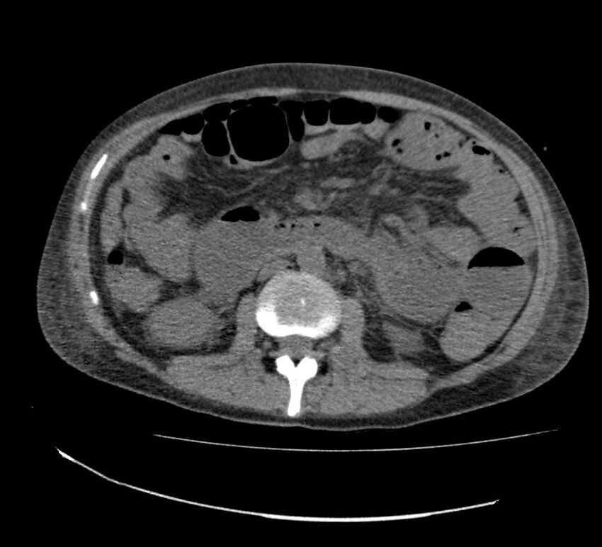 Bowel lymphoma complicated by bleeding after therapy (Radiopaedia 55601-62110 Axial non-contrast 39).jpg