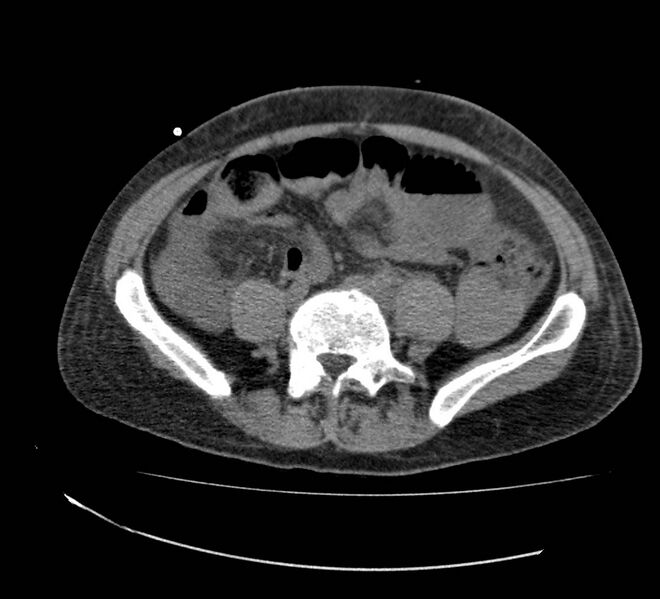 File:Bowel lymphoma complicated by bleeding after therapy (Radiopaedia 55601-62110 Axial non-contrast 55).jpg