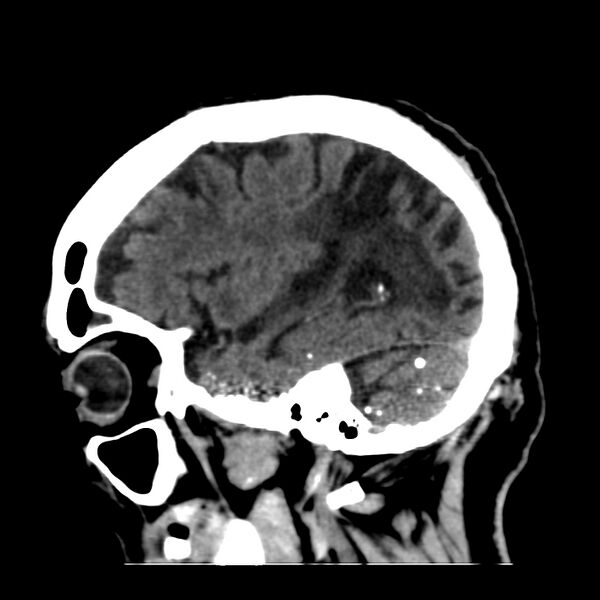 File:Brain Pantopaque remnants (Radiopaedia 78403-91048 C 16).jpg