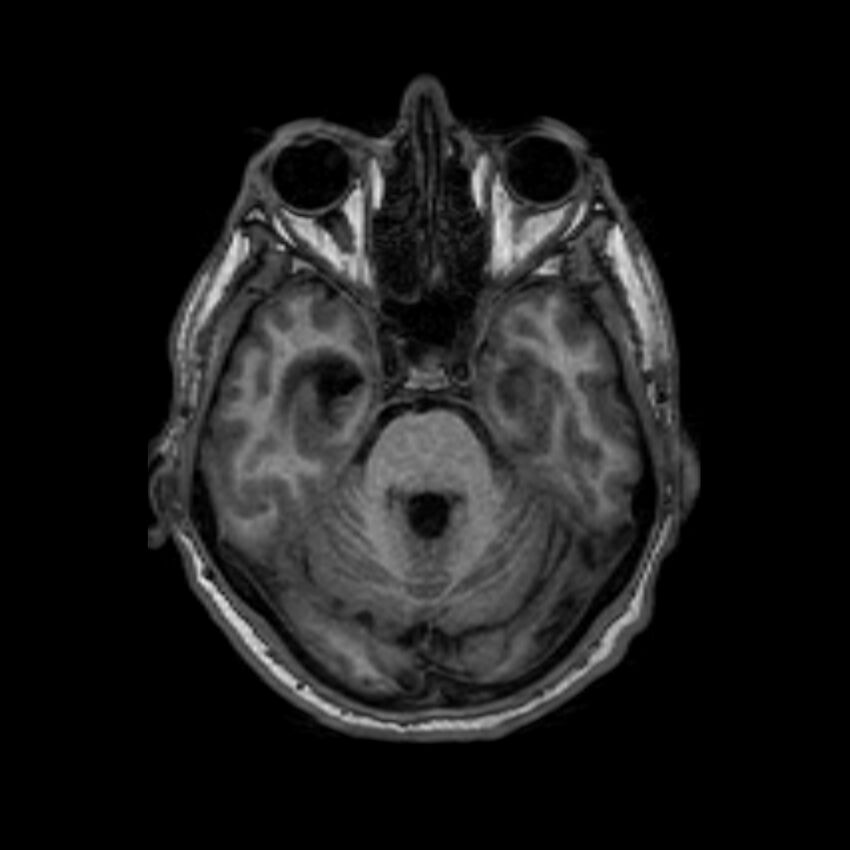 Brain abscess complicated by intraventricular rupture and ventriculitis (Radiopaedia 82434-96577 Axial T1 18).jpg