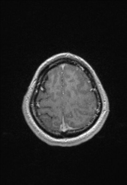 File:Brain abscess with ventriculitis (Radiopaedia 85703-101495 Axial T1 C+ 146).jpg
