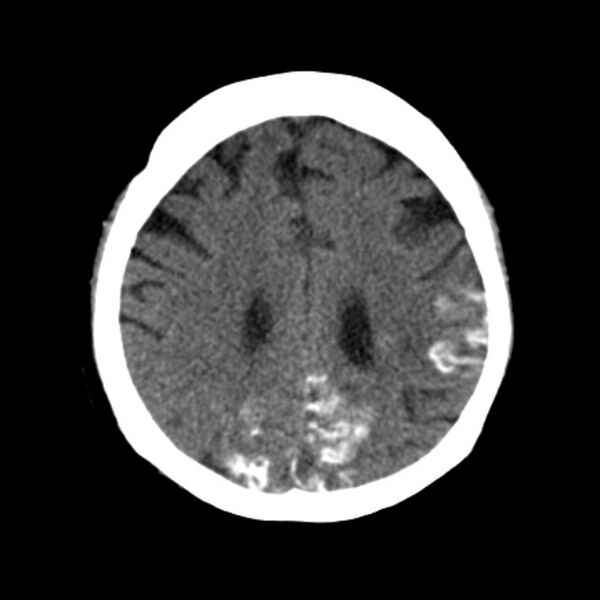 File:Brain cortical laminar necrosis (Radiopaedia 25822-25971 Axial non-contrast 31).jpg