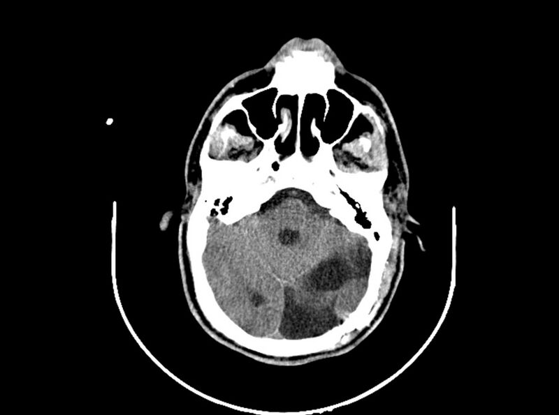 File:Brain injury by firearm projectile (Radiopaedia 82068-96088 A 93).jpg