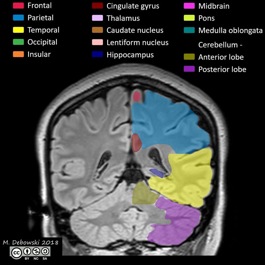 Brain lobes - annotated MRI (Radiopaedia 61691-69700 Coronal 49).JPG