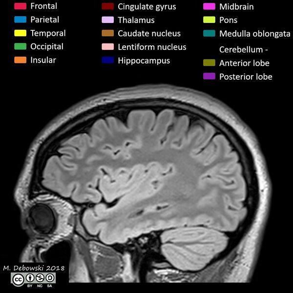 File:Brain lobes - annotated MRI (Radiopaedia 61691-69700 Sagittal 18).JPG