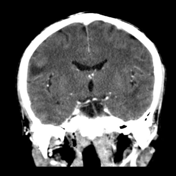 File:Brain metastases from lung cancer (Radiopaedia 24480-24781 Coronal C+ delayed 32).jpg