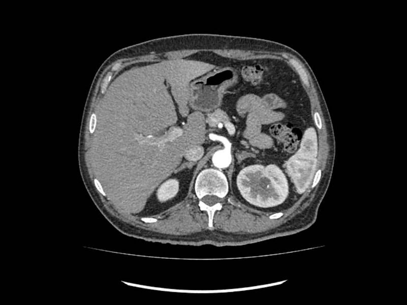 File:Brain metastases from renal cell carcinoma (Radiopaedia 42222-45328 A 30).jpg