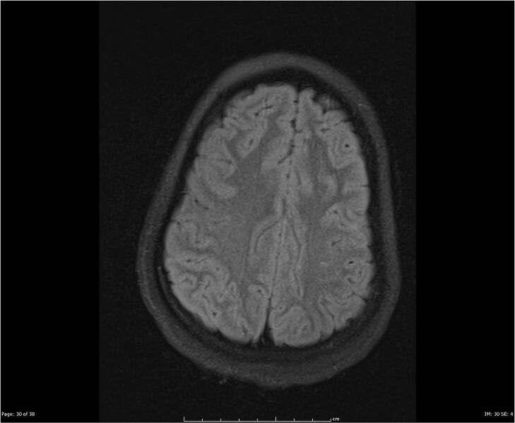 File:Brainstem glioma (Radiopaedia 21819-21775 Axial FLAIR 30).jpg