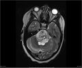 Brainstem glioma (Radiopaedia 21819-21775 Axial T2 12).jpg