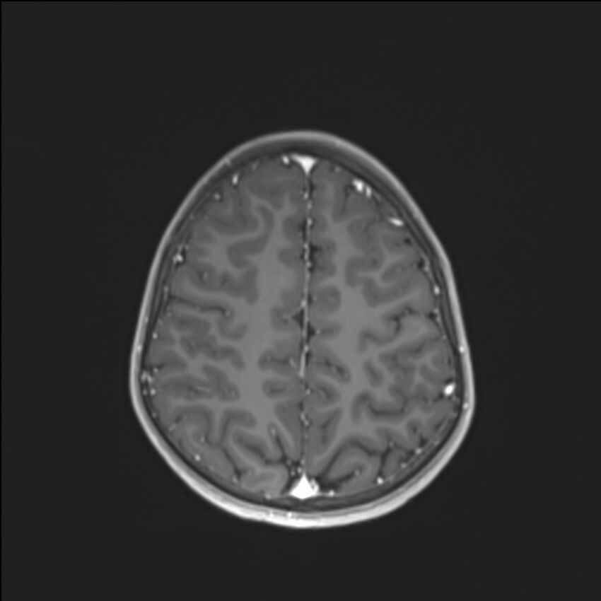 Brainstem glioma (Radiopaedia 70548-80674 Axial T1 C+ 121).jpg
