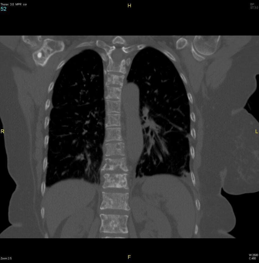 Breast primary with lung and bone metastases (Radiopaedia 40620-43228 bone window 52).jpg