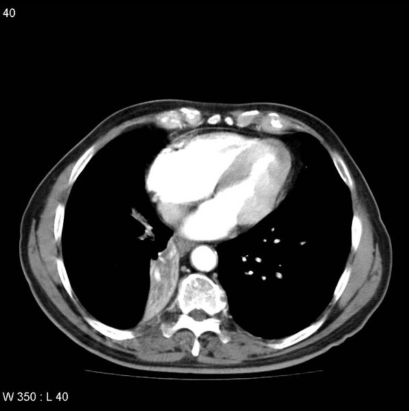 File:Bronchial carcinoid tumor with right lower lobe collapse (Radiopaedia 29060-29422 A 39).jpg