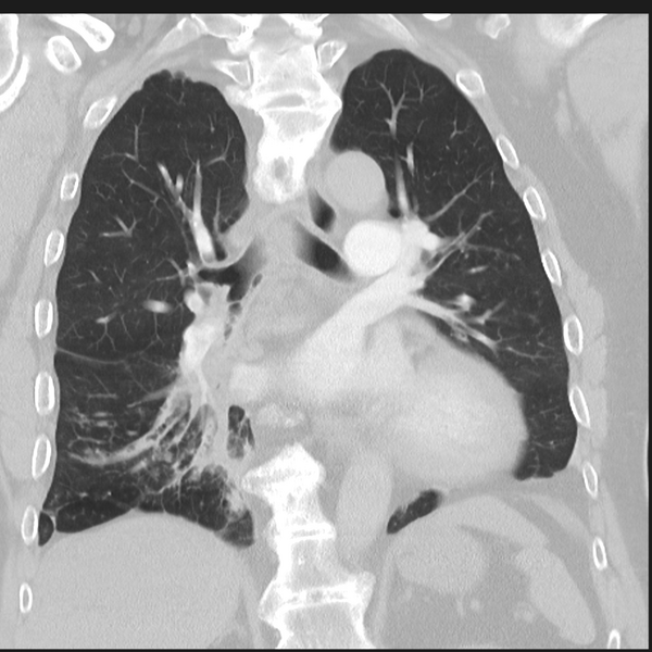File:Bronchiectasis (Radiopaedia 39385-41666 Coronal lung window 18).png