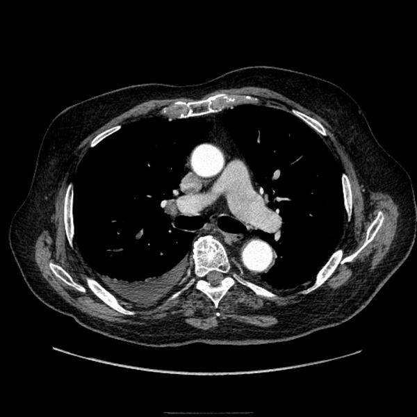 File:Bronchogenic adenocarcinoma and pulmonary embolism (Radiopaedia 9097-9806 D 29).jpg