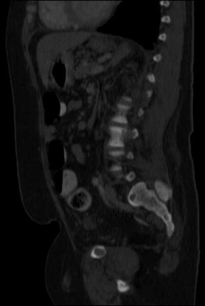 File:Brown tumors compressing the spinal cord (Radiopaedia 68442-77988 H 34).jpg