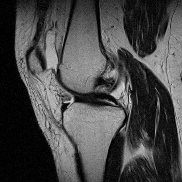 File:Bucket handle tear - medial meniscus (Radiopaedia 79028-91942 Sagittal T2 15).jpg