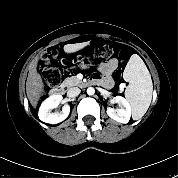 File:Budd-Chiari syndrome (Radiopaedia 27929-28177 Axial liver window 27).JPG