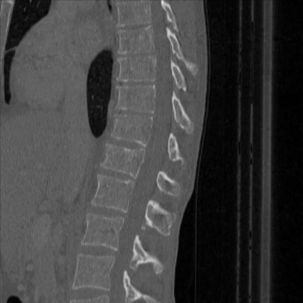 File:Bulging of paraspinal line in traumatic thoracal spinal compression fracture (Radiopaedia 29221-35872 Sagittal bone window 23).jpg