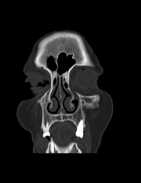 File:Burnt-out meningioma (Radiopaedia 51557-57337 Coronal bone window 3).jpg