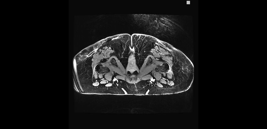 Buttock filler complications (Radiopaedia 63497-72115 Axial T1 C+ 43).jpg