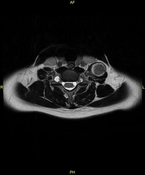 File:C5 nerve sheath tumor (Radiopaedia 85777-101596 Axial T2 52).jpg