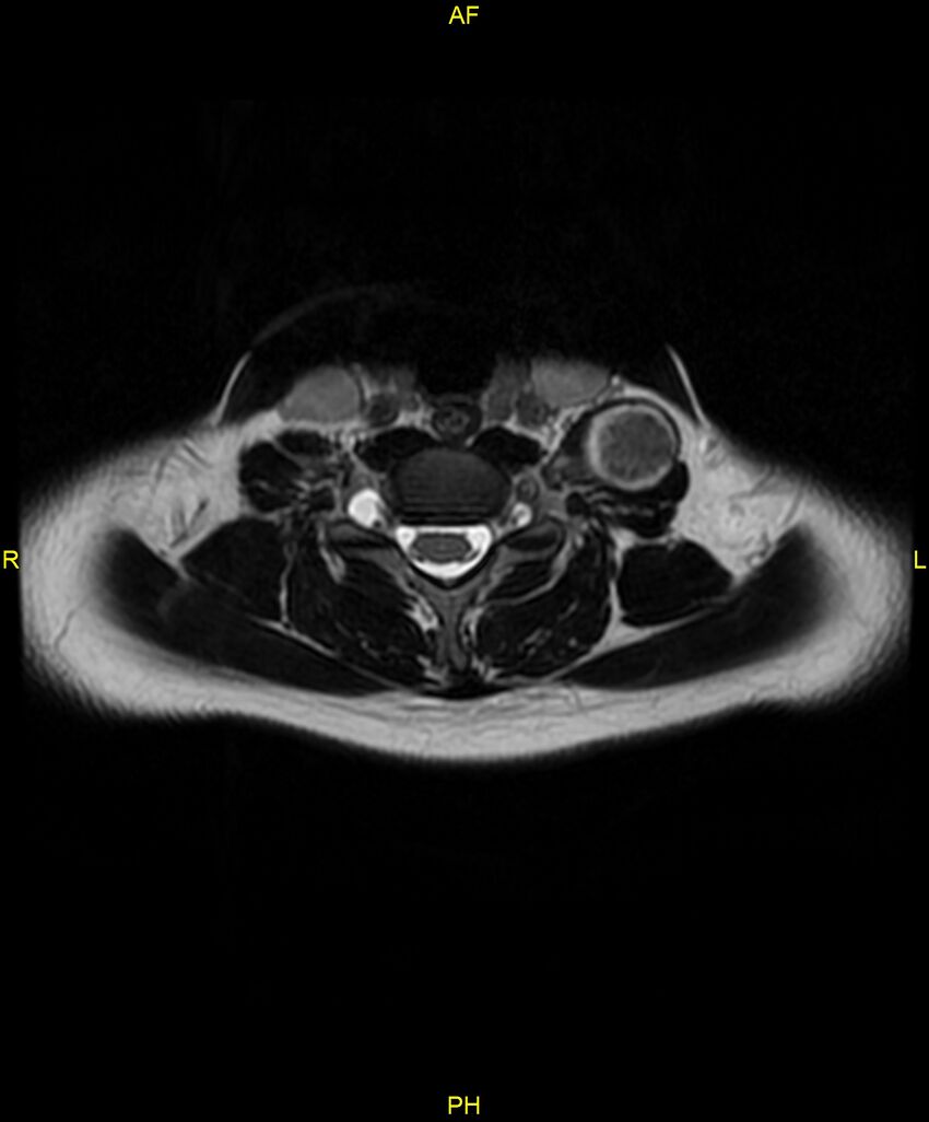 C5 nerve sheath tumor (Radiopaedia 85777-101596 Axial T2 52).jpg
