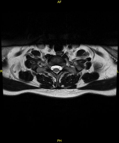 File:C5 nerve sheath tumor (Radiopaedia 85777-101596 Axial T2 70).jpg