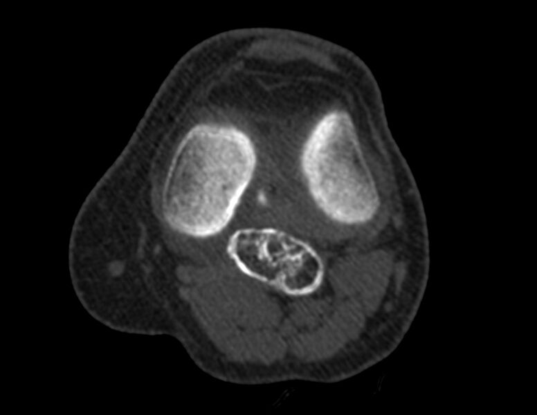 File:Calcified hematoma - popliteal fossa (Radiopaedia 63938-72763 Axial bone window 18).jpg