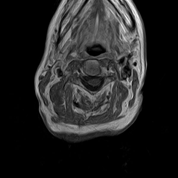 File:Calcified meningioma - cervical canal (Radiopaedia 70136-82468 Axial T1 C+ 15).jpg