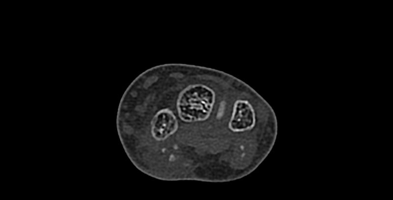 File:Calcifying aponeurotic fibroma (Radiopaedia 88423-105064 Axial bone window 72).jpg