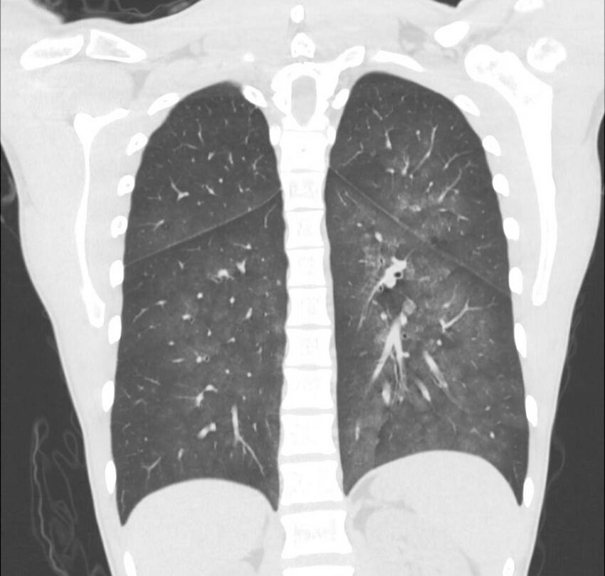 Cannabis-induced diffuse alveolar hemorrhage (Radiopaedia 89834-106946 Coronal lung window 27).jpg