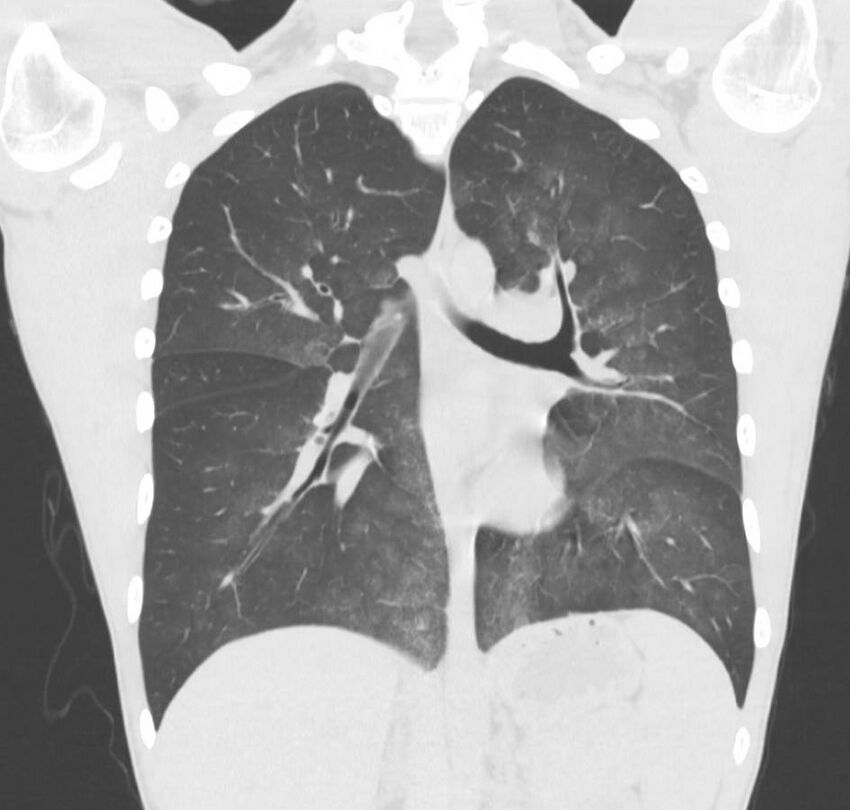 Cannabis-induced diffuse alveolar hemorrhage (Radiopaedia 89834-106946 Coronal lung window 40).jpg