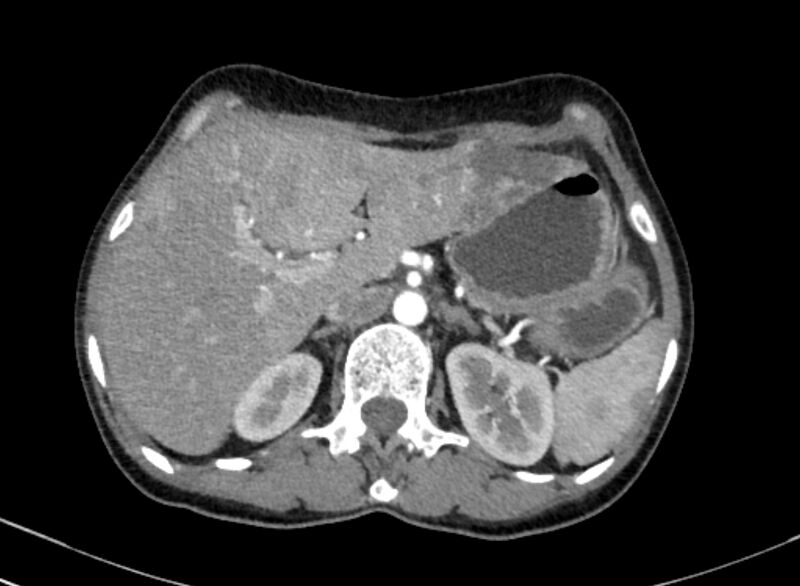 File:Cannonball metastases from breast cancer (Radiopaedia 91024-108569 A 122).jpg