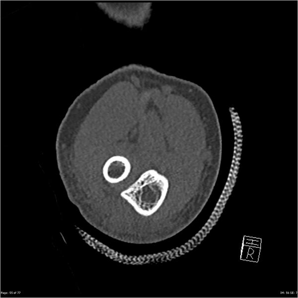 File:Capitellum fracture (Radiopaedia 23352-23426 Coronal bone window 55).jpg