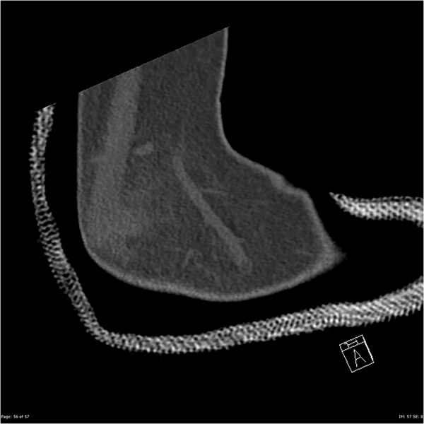 File:Capitellum fracture (Radiopaedia 23352-23426 Sagittal bone window 56).jpg