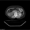 Carcinoma cervix- recurrence (Radiopaedia 34702-36137 B 74).jpg