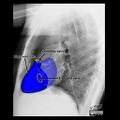 Cardiomediastinal anatomy on chest radiography (annotated images) (Radiopaedia 46331-50772 Q 3).jpeg