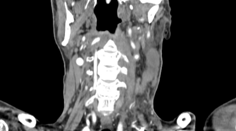 File:Carotid artery pseudoaneurysm (Radiopaedia 84030-99259 D 52).jpg