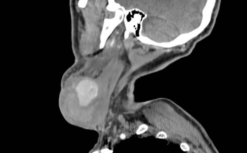 File:Carotid artery pseudoaneurysm (Radiopaedia 84030-99259 E 51).jpg