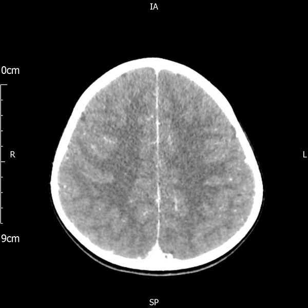 File:Cavernous sinus thrombosis (Radiopaedia 79414-92510 Axial Brain 138).jpg