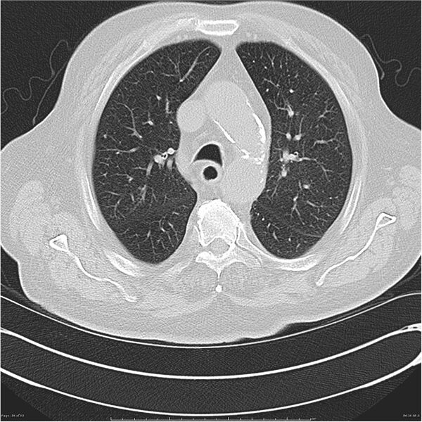 File:Cavitating left lower lobe lesion - squamous cell lung cancer (Radiopaedia 27749-28176 Axial lung window 16).jpg