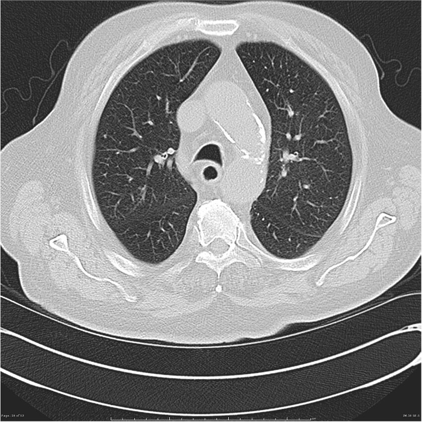 Cavitating left lower lobe lesion - squamous cell lung cancer (Radiopaedia 27749-28176 Axial lung window 16).jpg