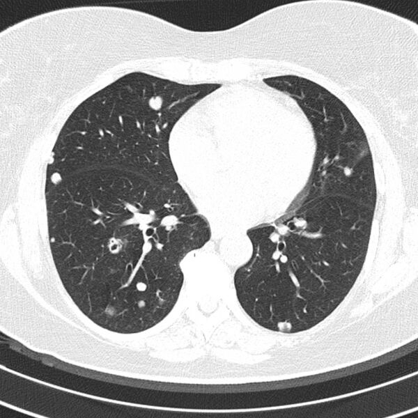 File:Cavitating pulmonary metastases (Radiopaedia 17796-17555 Axial lung window 12).jpg