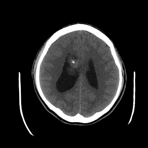 File:Central neurocytoma (Radiopaedia 79320-92379 Axial non-contrast 31).jpg