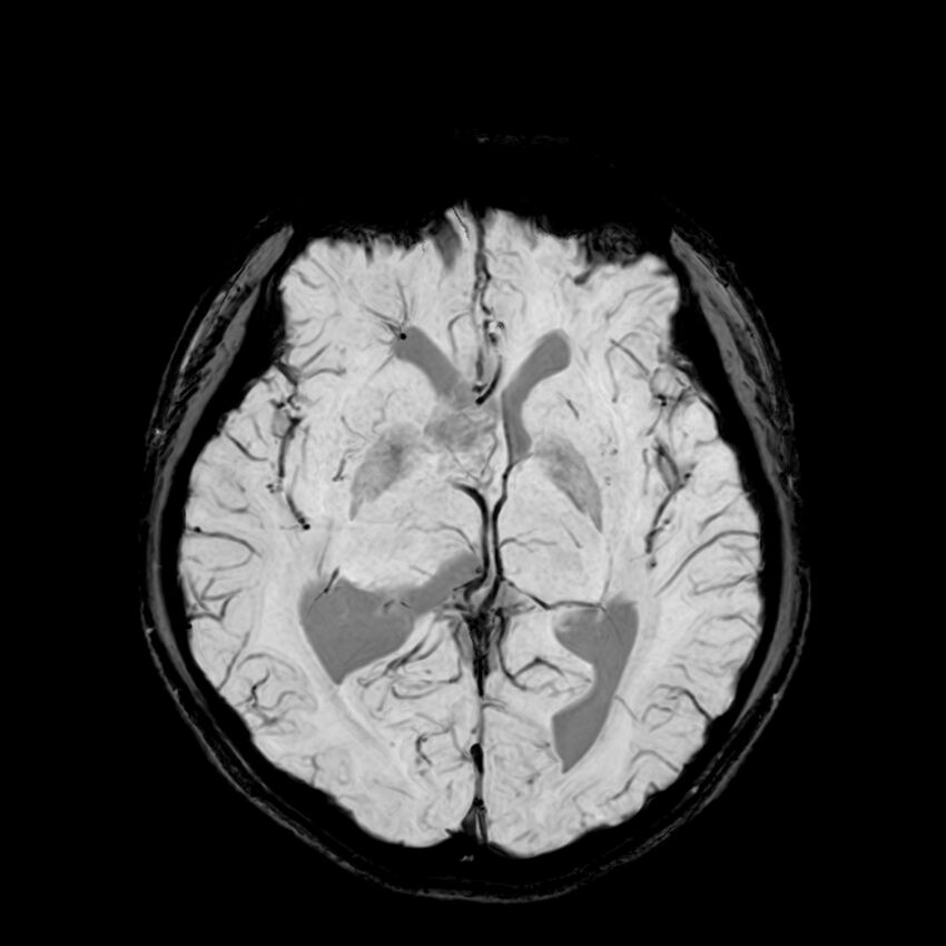 Central neurocytoma (Radiopaedia 79320-92380 Axial SWI 66).jpg