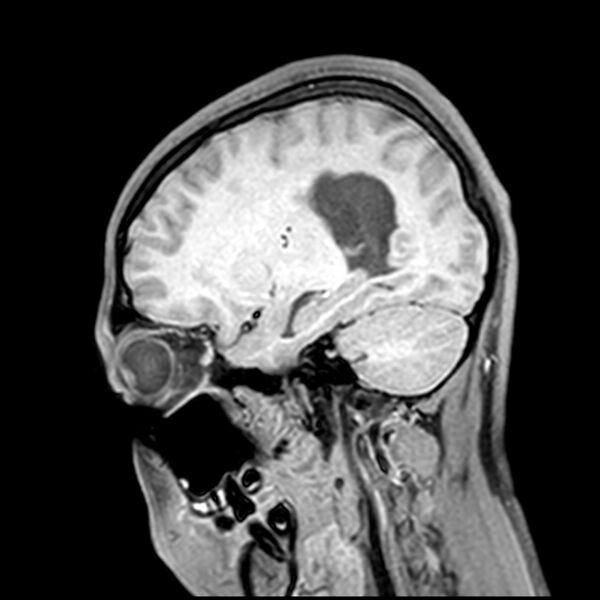 File:Central neurocytoma (Radiopaedia 79320-92380 Sagittal T1 179).jpg