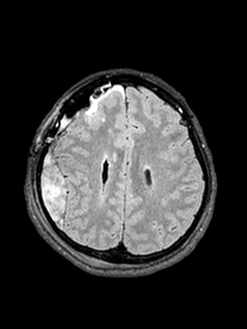 Central neurocytoma (Radiopaedia 79320-92381 Axial FLAIR 58).jpg