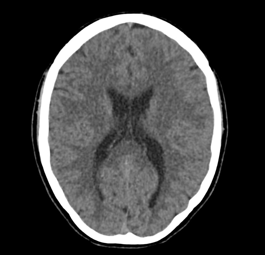 Cerebellar agenesis (Radiopaedia 30203-30817 Axial non-contrast 28).jpg