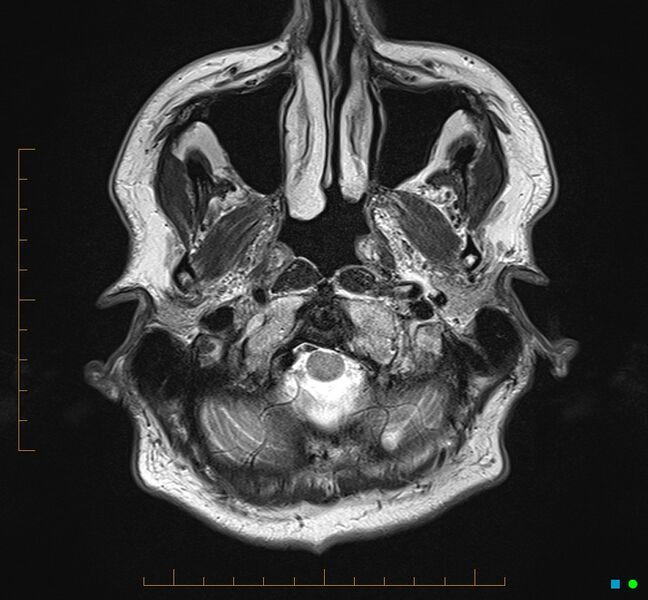 File:Cerebellar gangliocytoma (Radiopaedia 65377-74422 Axial T2 2).jpg