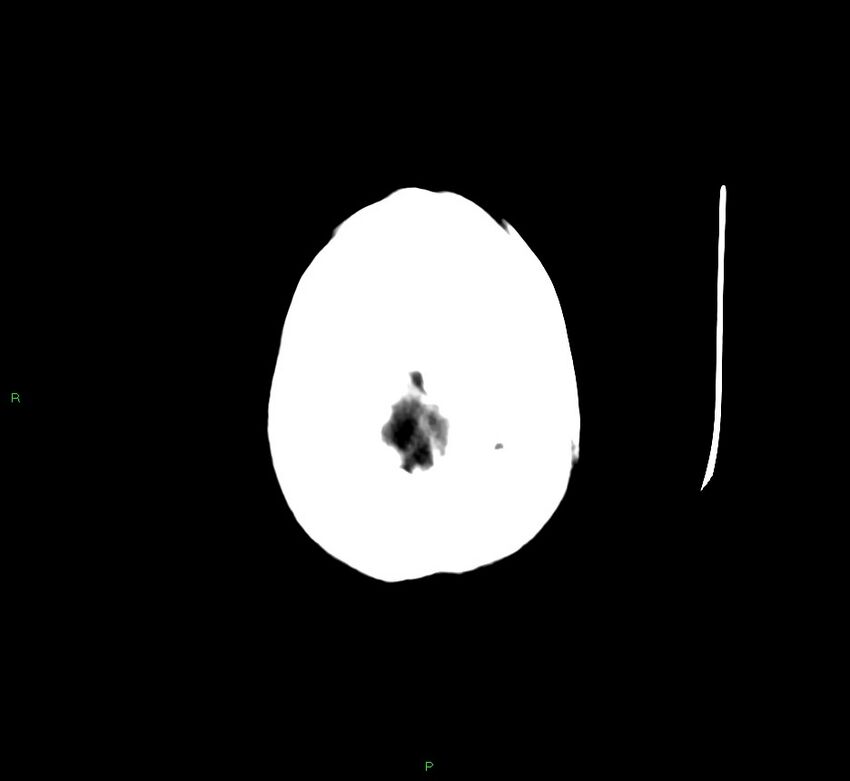 Cerebellar hemorrhage (Radiopaedia 58792-66026 Axial non-contrast 4).jpg